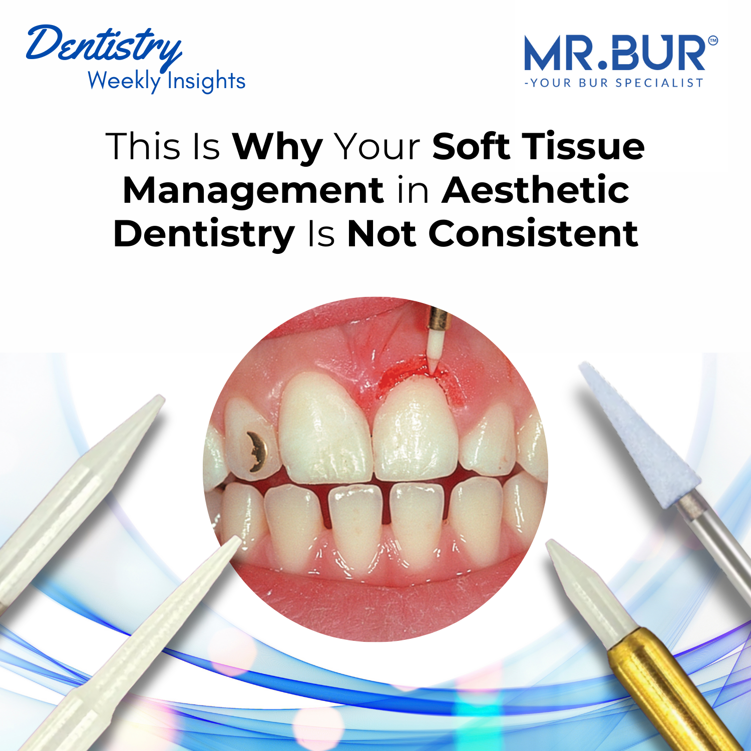 This Is Why Your Soft Tissue Management in Aesthetic Dentistry Is Not ...