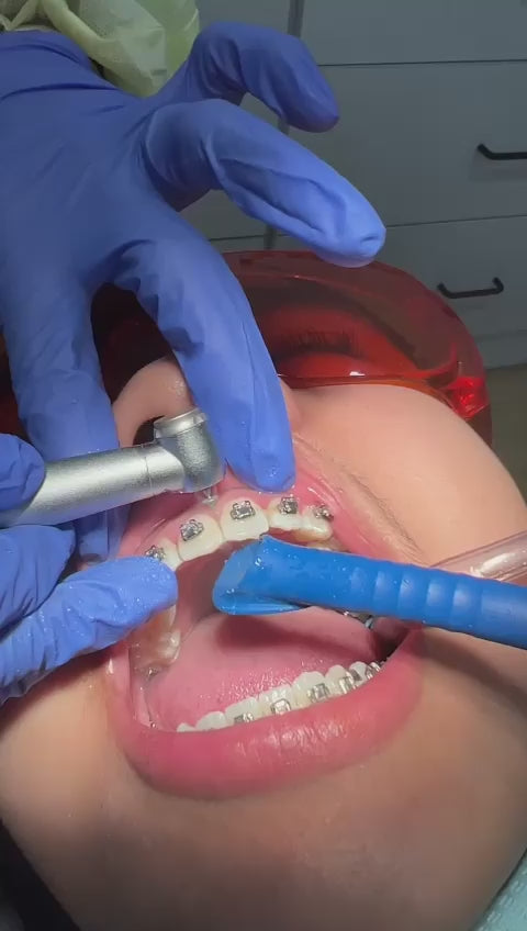 MR.BUR Interproximal Reduction Dental Bur. Available in 0.3mm, 0.4mm, 0.45mm, and 0.5mm for maximize precision and efficacy in interdental space adjustment and enamel reduction.