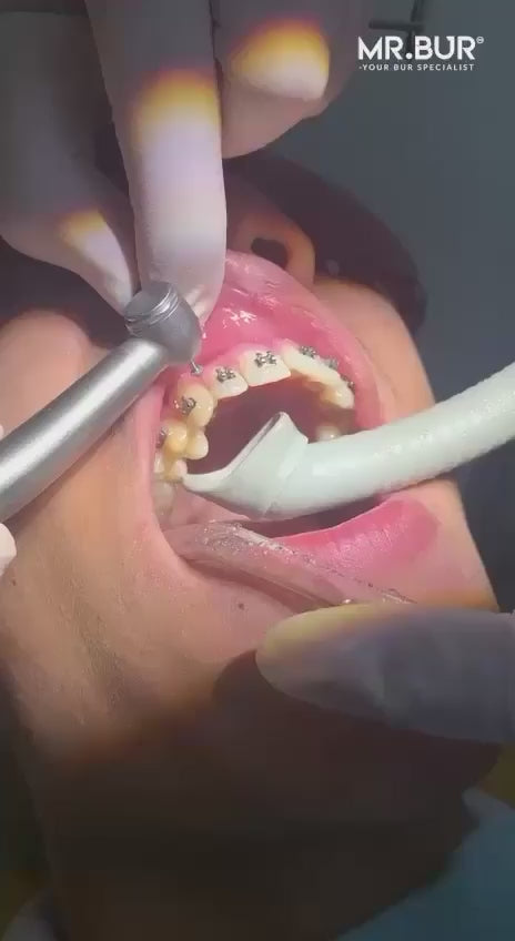 MR.BUR Interproximal Reduction Dental Bur. Available in 0.3mm, 0.4mm, 0.45mm, and 0.5mm for maximize precision and efficacy in interdental space adjustment and enamel reduction.