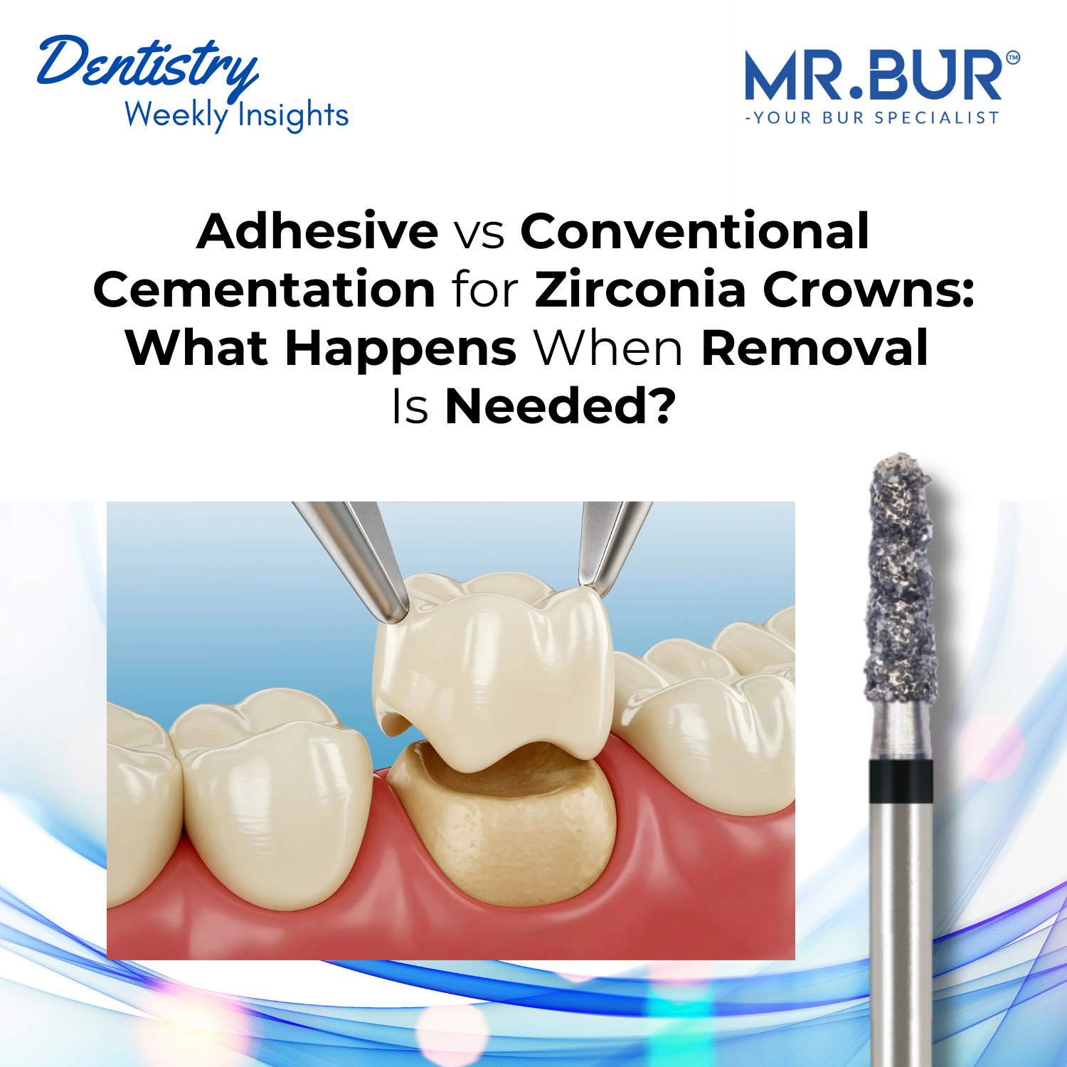 Zirconia Crown Cementation Explained: Adhesive vs Conventional and Rem ...