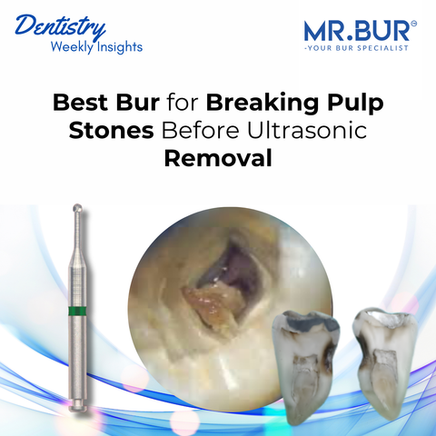 Mr. Bur Round Tungsten Carbide Bur RA Long Neck used for controlled pulp stone removal and deep endodontic access demonstrating efficient cutting and improved visibility in calcified pulp chamber.