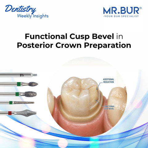 MR.Bur functional cusp bevel in posterior crown preparation showing additional cusp reduction and dental burs for controlled anatomical occlusal clearance.