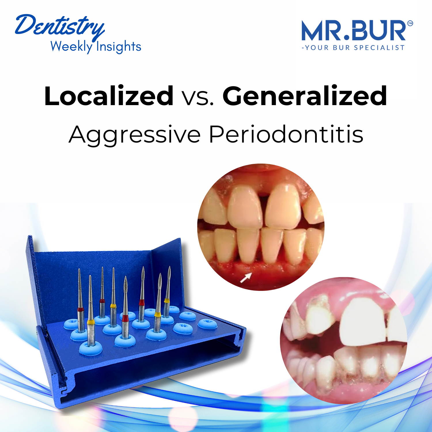 Localized vs. Generalized Aggressive Periodontitis – Mr Bur