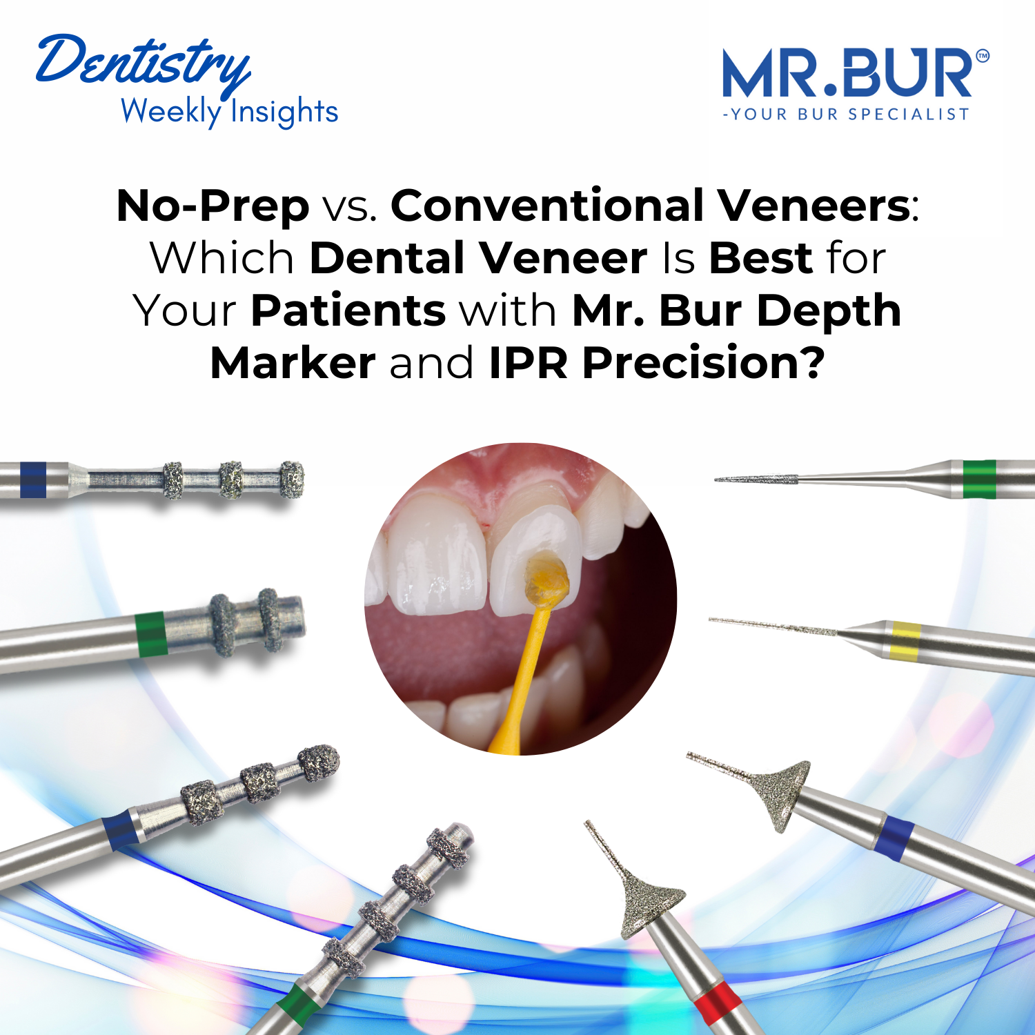 Between Prep Choosing Between No-Prep and Conventional Veneers with Mr. Bur Depth M ...