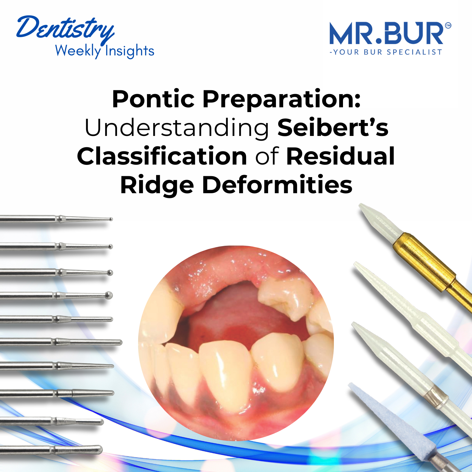 Siberet Ridge Defect Pontic Preparation: Understanding Seibert’s Classification of Residual ...