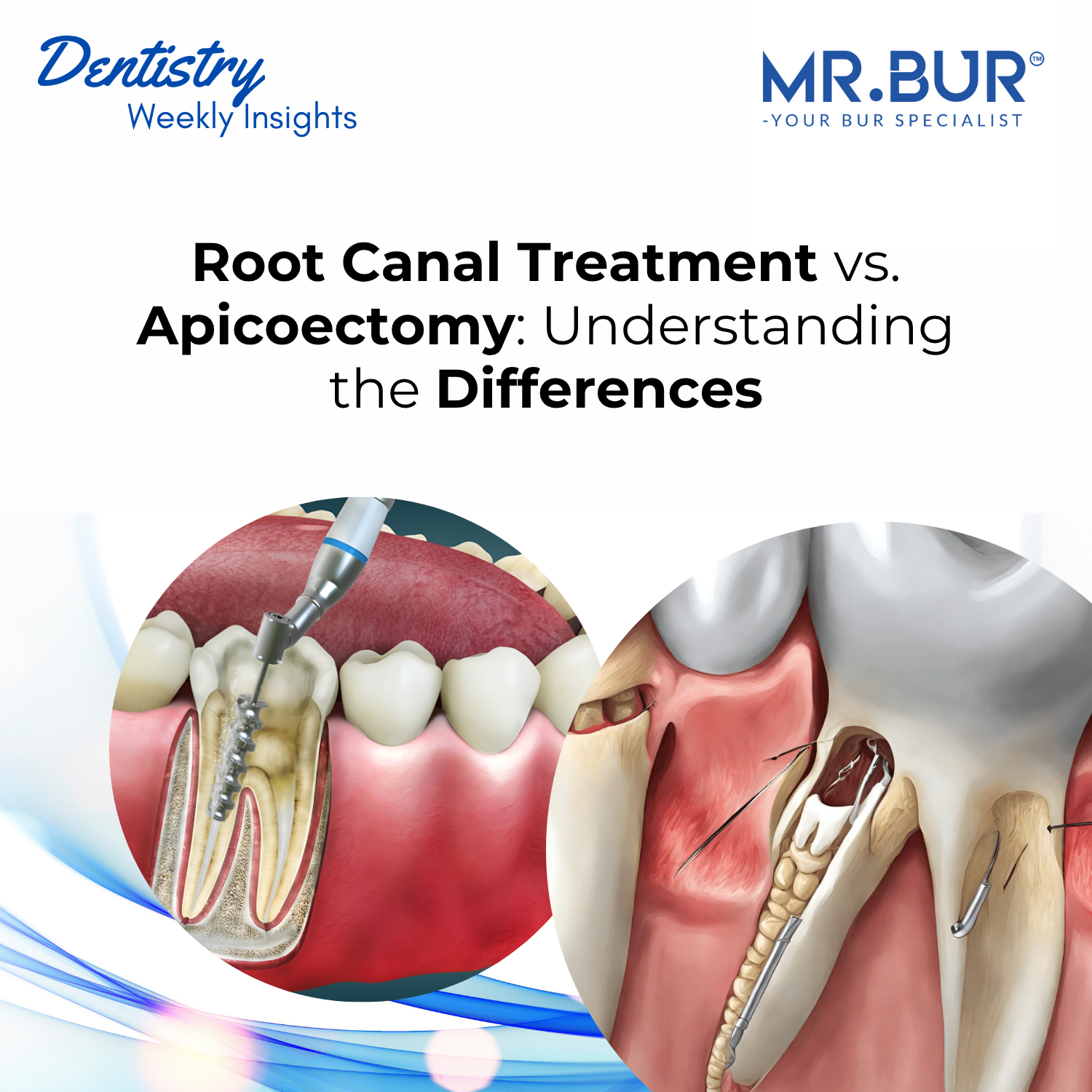 Root Canal Treatment vs. Apicoectomy: Key Differences, Indications, an ...