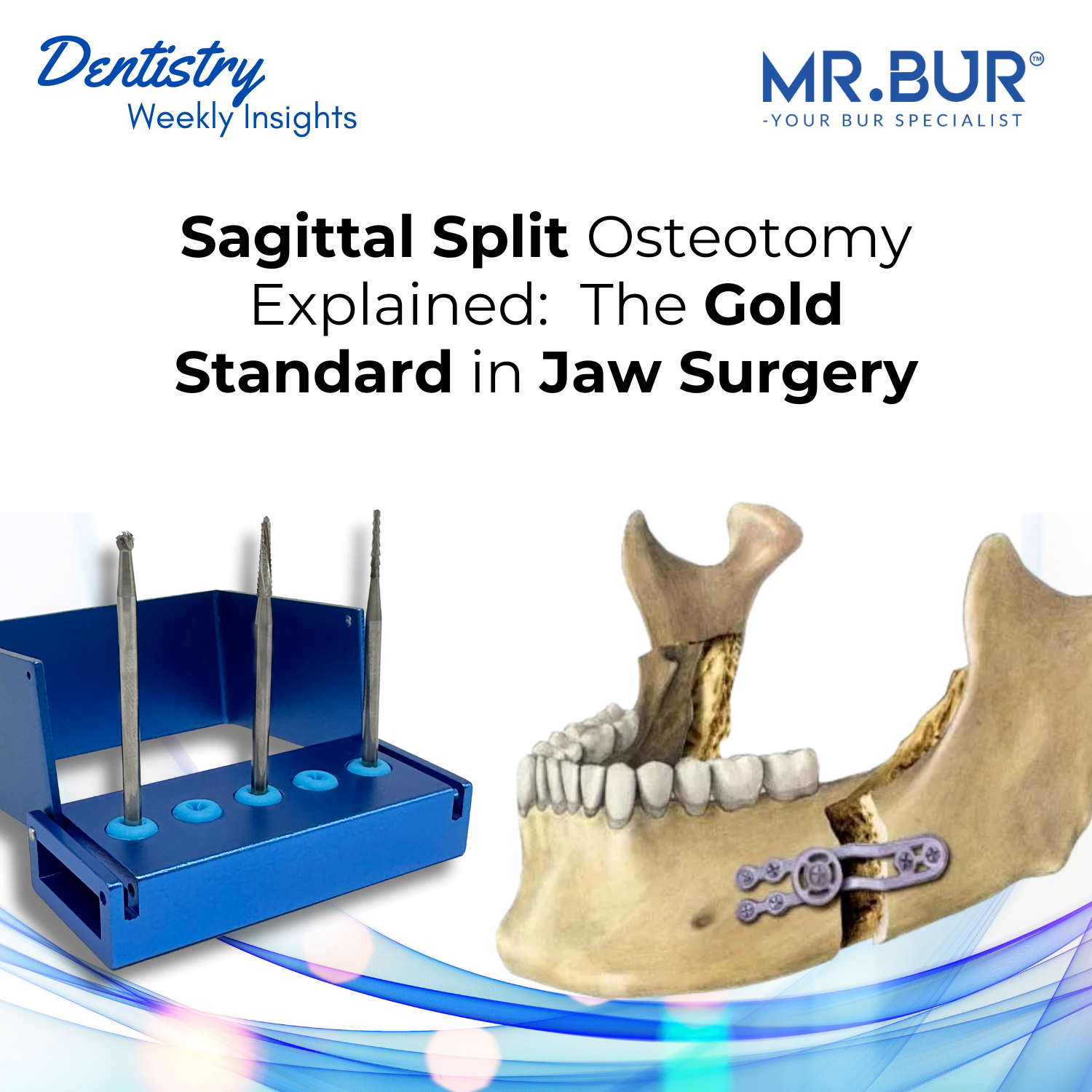 Sagittal Split Osteotomy Explained: The Gold Standard in Jaw Surgery ...