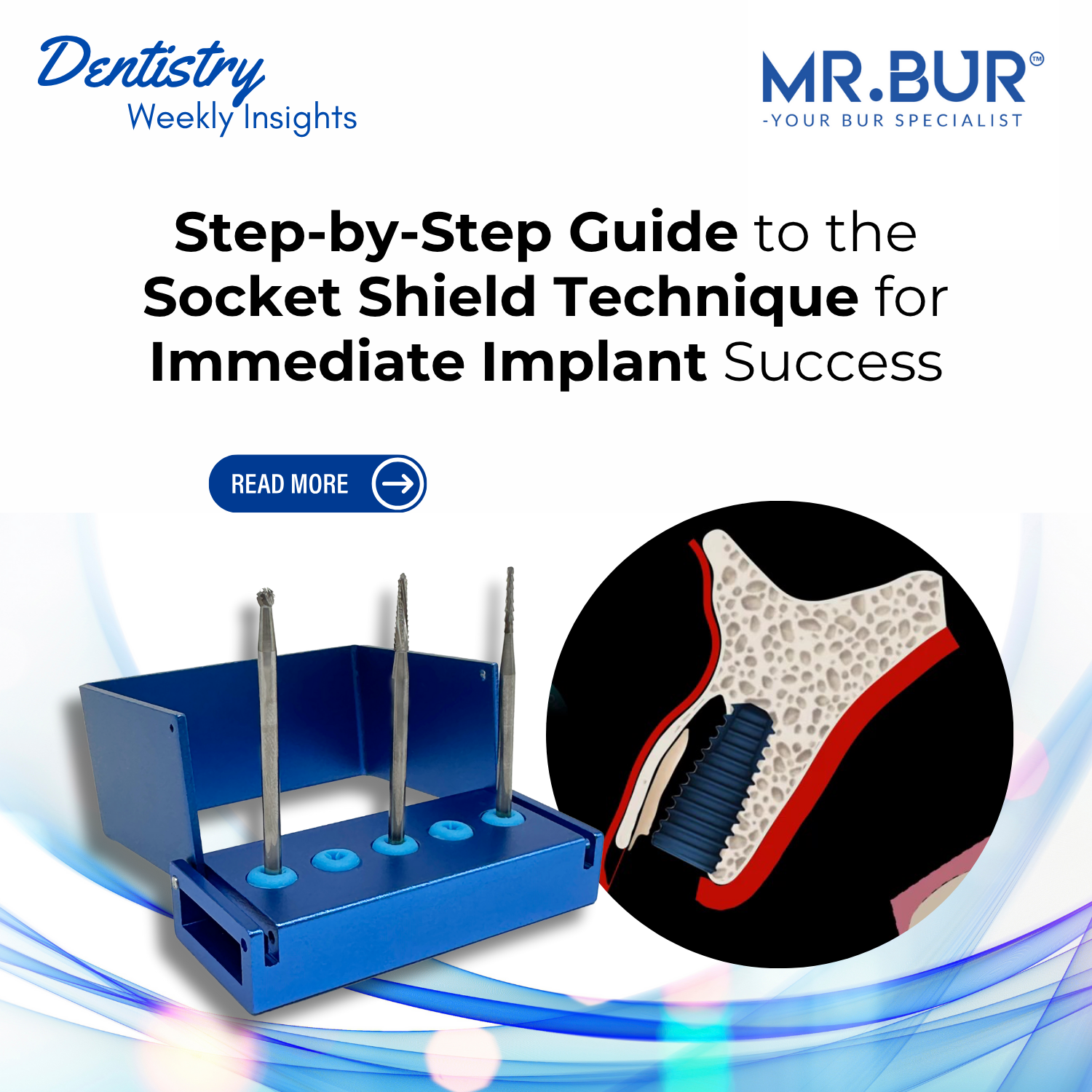 Step-by-Step Guide to the Socket Shield Technique for Immediate Implan ...
