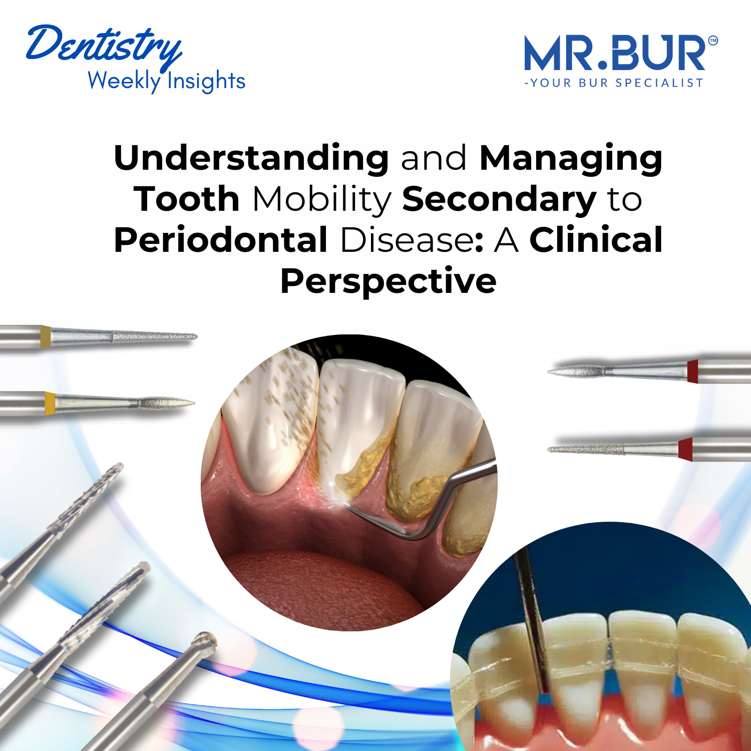 Understanding and Managing Tooth Mobility Secondary to Periodontal Dis ...