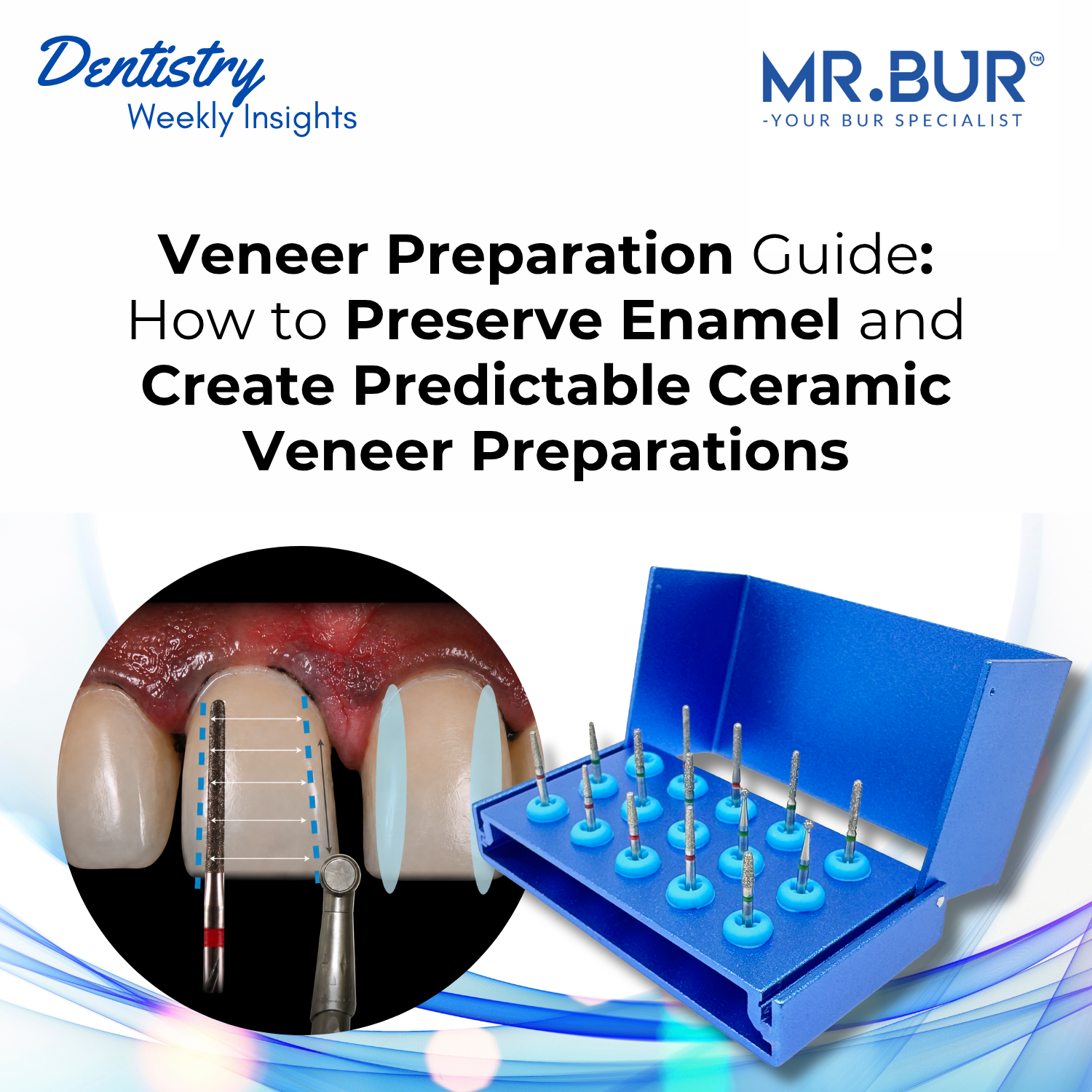 Veneer Preparation Guide: Enamel Preservation, Tooth Reduction and Cer ...