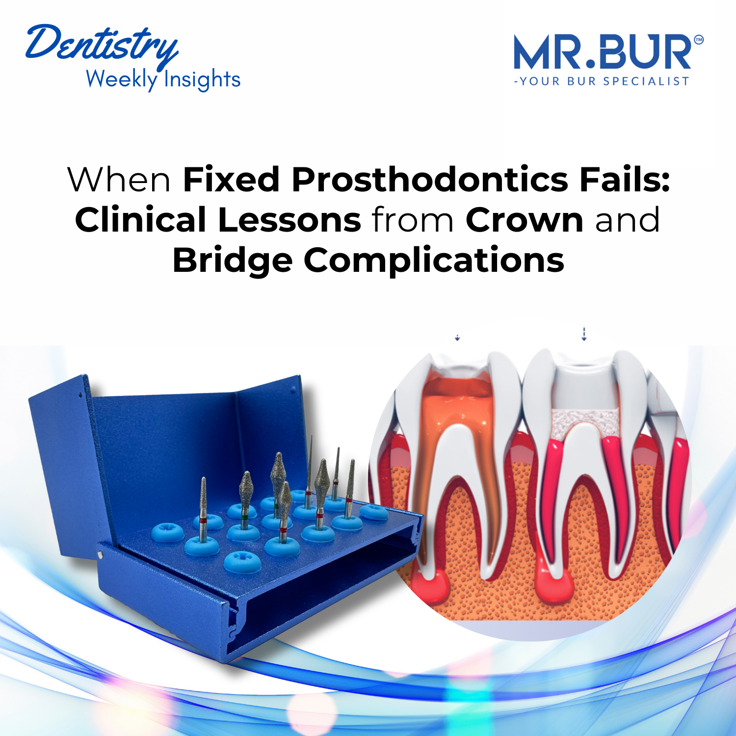Fixed Prosthodontics Failure: Causes, Complications, and Clinical Solu ...
