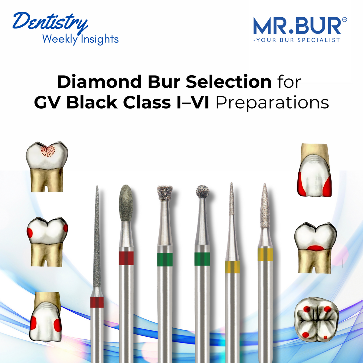 Types of Dental Veneers: Pros, Cons, and When to Use Them – Mr Bur