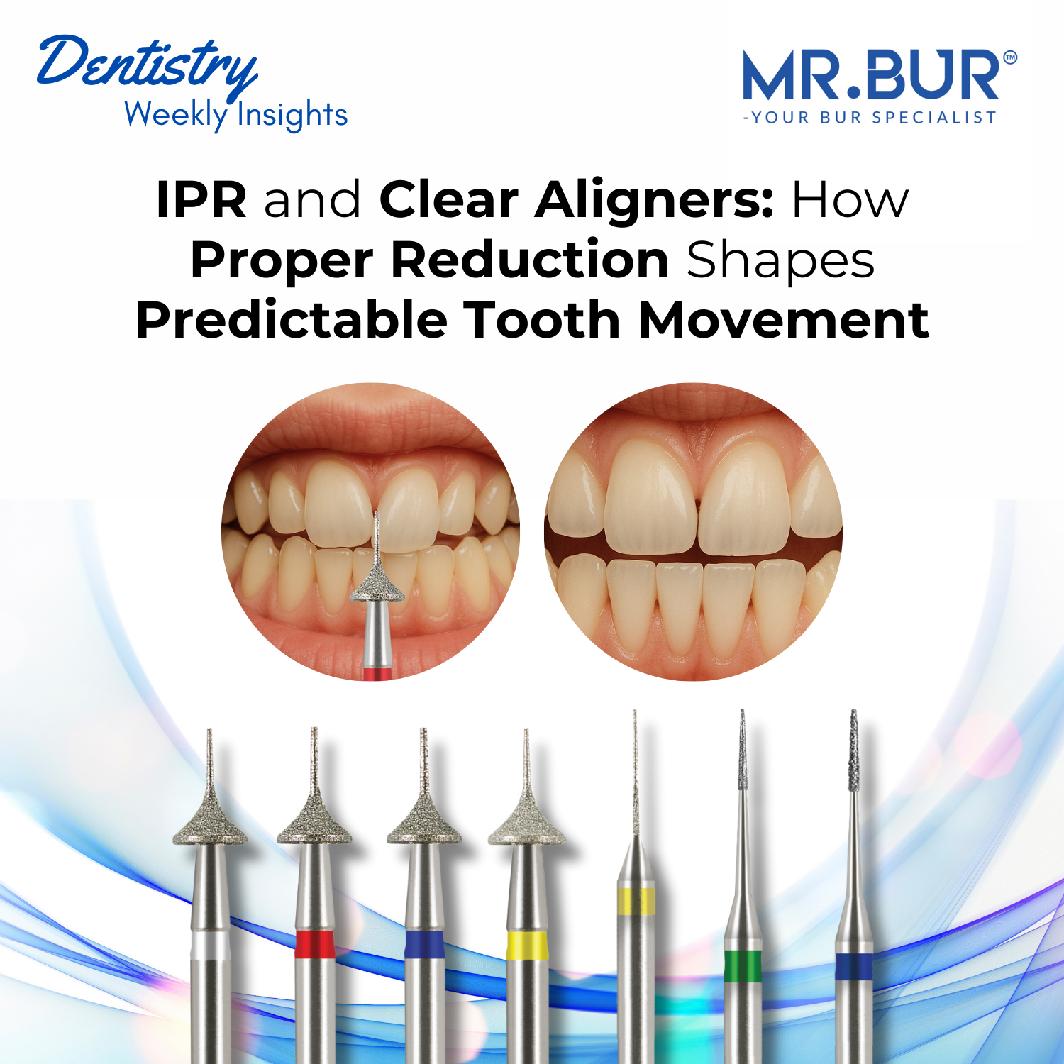 IPR and Clear Aligners: How Proper Interproximal Reduction Ensures Pre ...