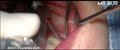 Mr. Bur Periodontal Root Planing Bur ensures precise, efficient removal of calculus and infected cementum, enhancing periodontal health and tissue healing.