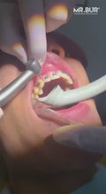 MR.BUR Interproximal Reduction Dental Bur. Available in 0.3mm, 0.4mm, 0.45mm, and 0.5mm for maximize precision and efficacy in interdental space adjustment and enamel reduction.