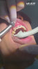 MR.BUR Interproximal Reduction Dental Bur. Available in 0.3mm, 0.4mm, 0.45mm, and 0.5mm for maximize precision and efficacy in interdental space adjustment and enamel reduction.