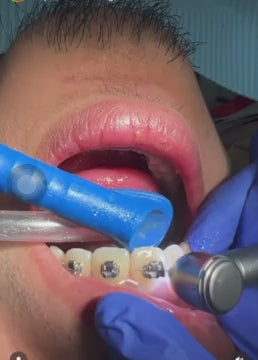 MR.BUR Interproximal Reduction Dental Bur. Available in 0.3mm, 0.4mm, 0.45mm, and 0.5mm for maximize precision and efficacy in interdental space adjustment and enamel reduction.